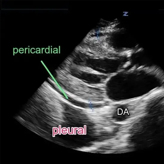 Ultrasound Pericardial Effusion